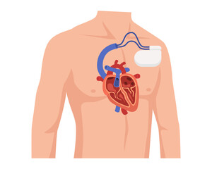 Man wear pacemaker in his chest, battery-powered electronic device, heart's rhythm electrical impulses heart muscle, cardiac heart tool device vector illustration