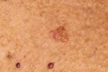 Basal cell carcinoma on the chest of a seventy year old Caucasian woman who has lived all her life...