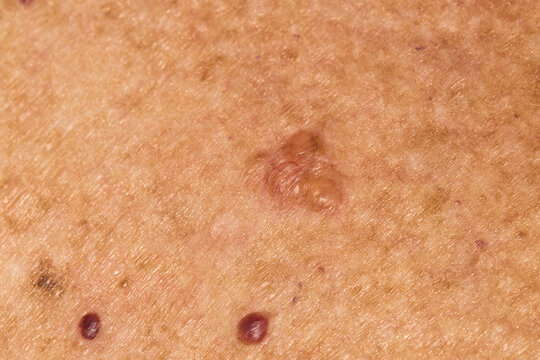 Basal cell carcinoma on the chest of a seventy year old Caucasian woman who has lived all her life in Africa