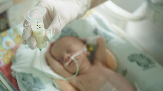 A premature infant receives milk feeding in a neonatal intensive care unit (NICU), highlighting the care for vulnerable newborns. Premature Infant Milk Feeding in NICU