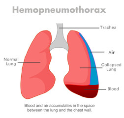 Hemopneumothorax, blood and air in lungs. Blood collects in pleural cavity. Lungs collapse, failure and disorder, respiratory system diseases. Hemothorax, pneumothorax. Vector illustration