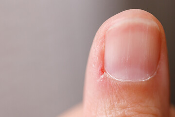Macro close-up of a human finger with an inflamed hangnail and visible skin irritation. Useful for dermatology, skincare products, or nail care industry.