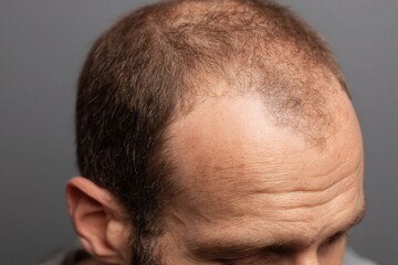 Fototapeta premium Close-up of a man experiencing hair loss, showcasing baldness from the top of his head to the bottom, highlighting the effects of male pattern baldness.
