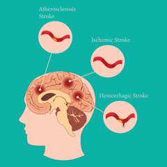Human brain with stroke types: atherosclerosis, ischemic, and hemorrhagic illustration.