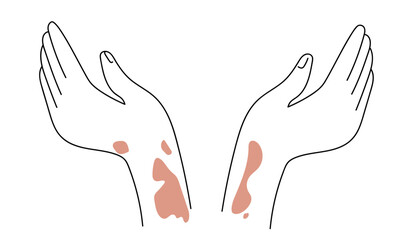 Human hands with symptoms of psoriasis on her skin, banner for Psoriasis awareness month.  Linear  vector illustration.