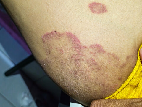 Granuloma anulare, skin change on the inner thigh