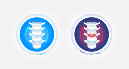 Healthy vertebrae bone and arthritis or osteoporosis with red blue arrows spin around. Joint cartilage becomes worn. Comparative images of normal and inflammation bones. Vector EPS10.