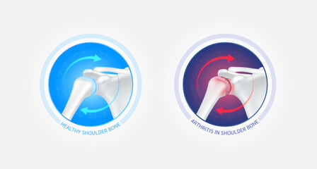 Healthy shoulder bone and arthritis or osteoporosis with red blue arrows spin around. Joint cartilage becomes worn. Comparative images of normal and inflammation bones. Vector EPS10.