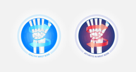 Healthy wrist bone and arthritis or osteoporosis with red blue arrows spin around. Joint hand cartilage becomes worn. Comparative images of normal and inflammation bones. Vector EPS10.