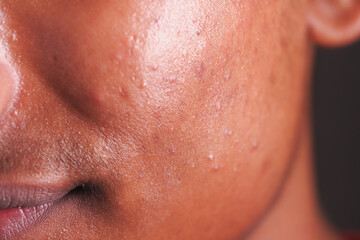 Skin close-up showing texture and blemishes on a face