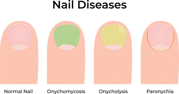 Nail Diseases Onychomycosis Onycholysis and Paronychia Vector Illustration