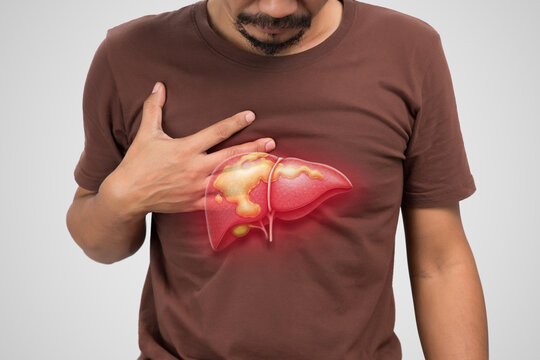 Illustration of a man experiencing fatty liver disease, showing discomfort, liver inflammation, and related symptoms. A medical concept for liver health awareness.