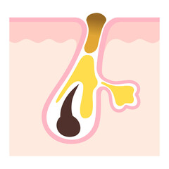 毛穴の断面　角栓と皮脂　詰まった毛穴