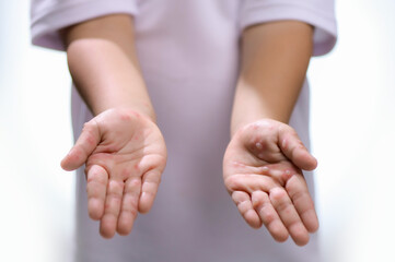 Hand, foot and mouth disease HFMD Human hand of scarlet fever in coxsackievirus palmarosa virus and...