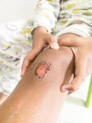 KIDS WOUNDS INJURED AFTER FALLING