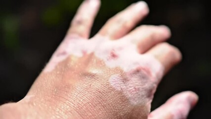 Close-up of a hand showing vitiligo, unique skin textures and the visual aspect of the disorder