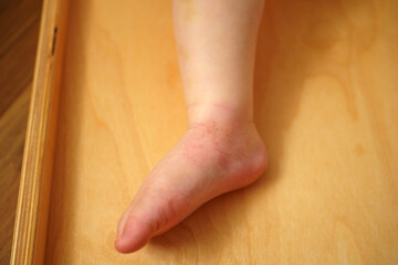 Redness from mosquito bite on a baby foot resting on a wooden surface during a sunny afternoon