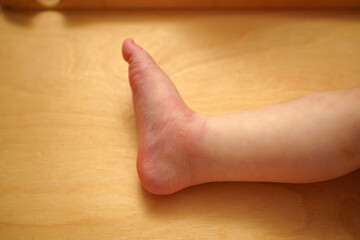 A child leg shows noticeable redness and swelling at the site of a mosquito bite