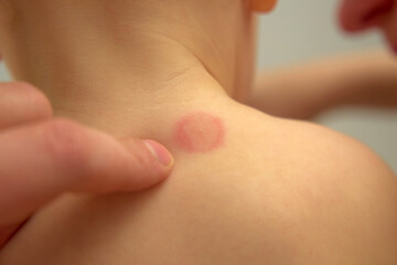 View of a child shoulder displaying a mosquito bite that has caused noticeable redness and irritation