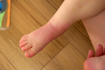 Visible knee has a distinct red mosquito bite surrounded by slight swelling from outdoor play.