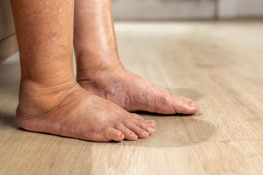 Elderly woman has edema or swelling foot.