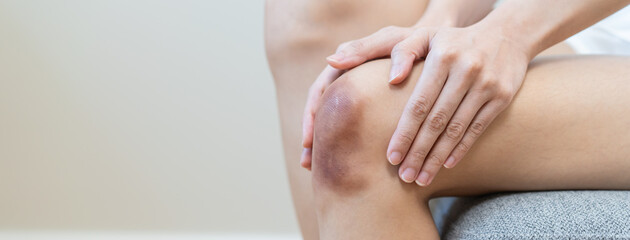 Close up of stain bruise wound on arm, contusion asian young woman, girl an accident fell down...