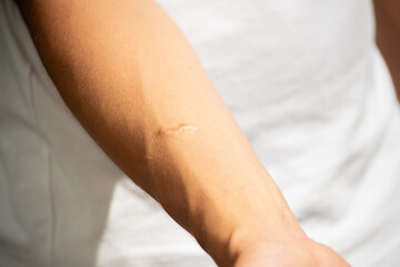 Close-up of a noticeable scar on a man's arm, highlighting the texture and healing process. Represents resilience, past experiences, or dermatological concepts.