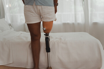 A woman with a prosthetic leg is standing in front of a bed