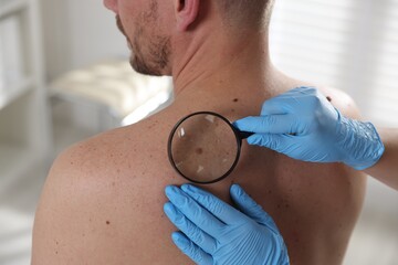Doctor examining man's moles in hospital, closeup