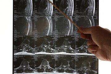 Doctors analyze an MRI image of the spine.  Methods of diagnosis of diseases and pathologies of the...