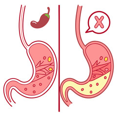 Human stomach. Healthy and unhealthy, Bloating stomach ache, digestive tract pain fullness heaviness stomaches acid heartburn process