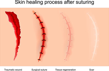 Skin Wound healing following suture closure.