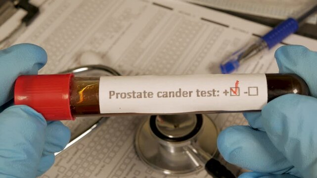 Doctor showing positive prostate cancer test result