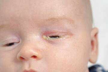 Baby eyes with eye mucus in selective focus. Disease tear ducts tons of newborns close up....