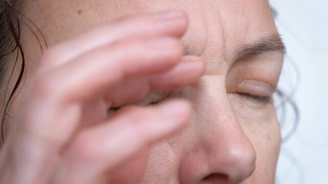Allergy in puffy eyes. A woman suffers from severe allergies in her eyes.