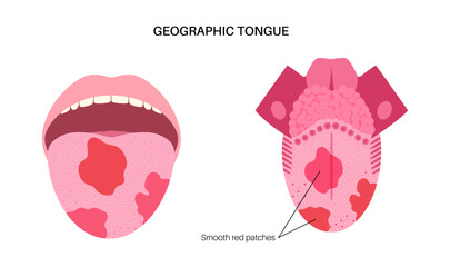 Geographic tongue poster