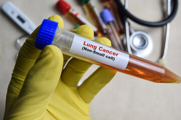 Lung cancer - Non-small cell Test with blood sample in yellow gloved hands. healthcare or Medical...