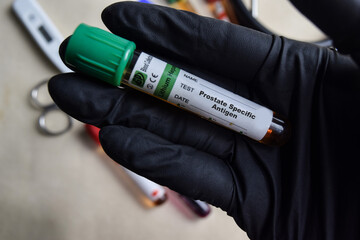 Prostate Spesific Antigen - Test with blood sample in black gloved hands. healthcare or Medical...