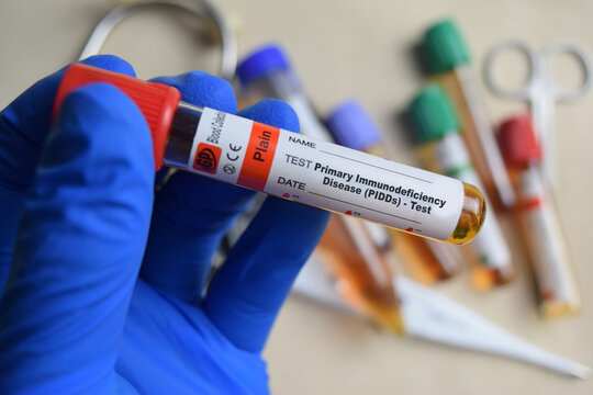 Primary Immunodeficiency Disease - PIDDs - Test with blood sample in blue gloved hands. healthcare or Medical concept