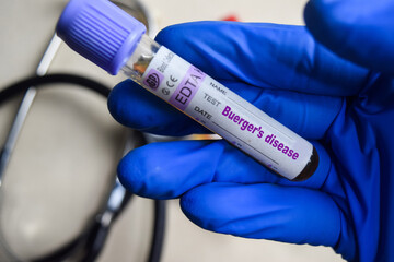 Thromboangiitis obliterans. Buergers Disease - Test with blood sample in blue gloved hands....