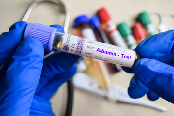 Albumin- Test with blood sample in blue gloved hands. healthcare or Medical concept