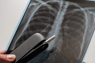 Electronic cigarette and lung x-ray. Tobacco heating system. 