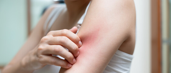 skin problem and beauty. Young woman scratch body has itchy skin from skin allergic, steroid...