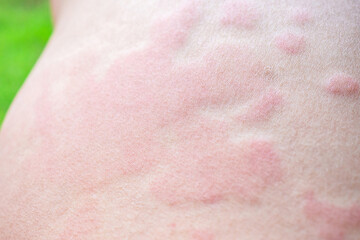 Skin allergy rash dermatitis texture close up