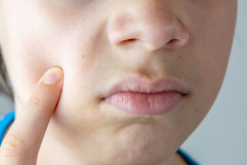 Young male teen examines pimple in mirror, highlighting self-image issues and teenage skin concerns