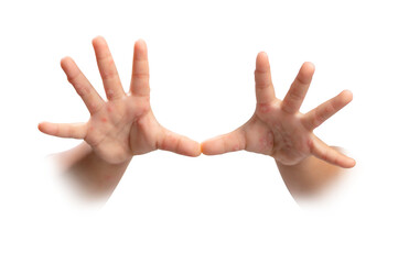 Hand, foot and mouth disease HFMD Human hand of scarlet fever in coxsackievirus palmarosa virus and child hand on white background