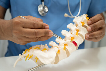 Asian doctor holding spinal nerve and bone model, Lumbar spine displaced herniated disc fragment...