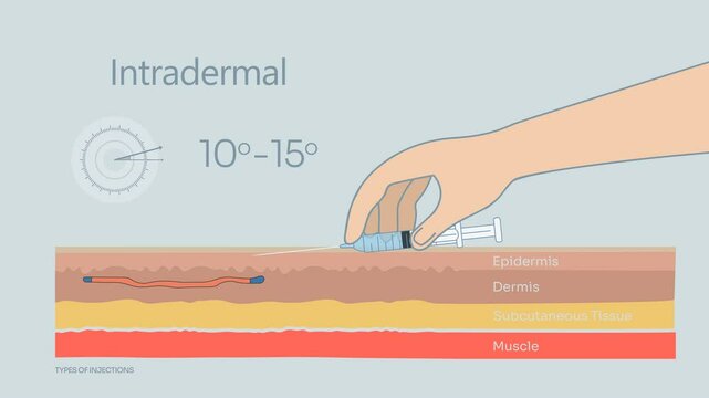 Types of Injections - animated loop