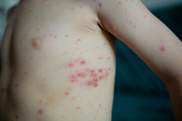 Child torso covered with chickenpox rash. Skin with red itchy blisters caused by varicella virus....