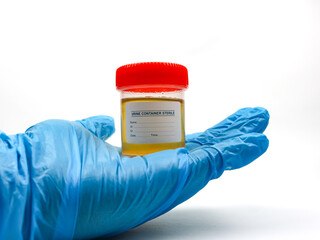 Gloved hand holding a sterile urine sample container with a red lid.